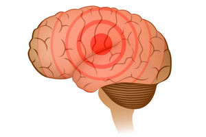 Генерализованная эпилепсия