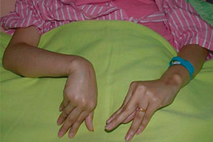 Тонические судороги.