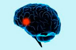 Височная эпилепсия